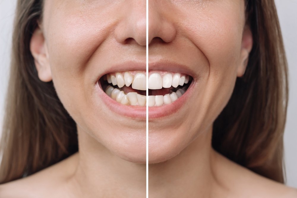 Difference between porcelain veneers and crowns