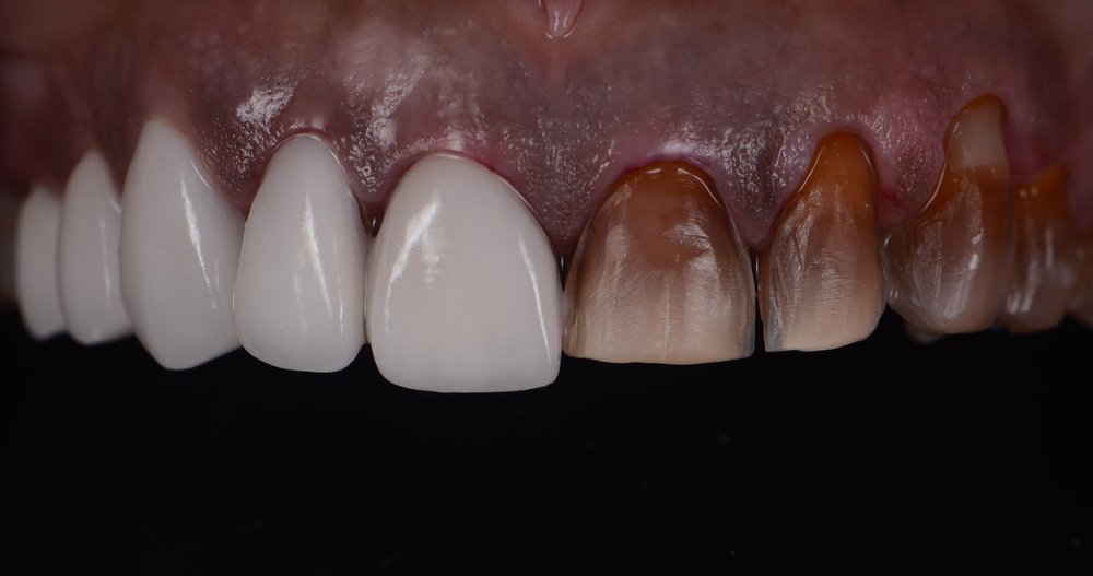 Maintenance and Care Prolonging the Life of Your Veneers