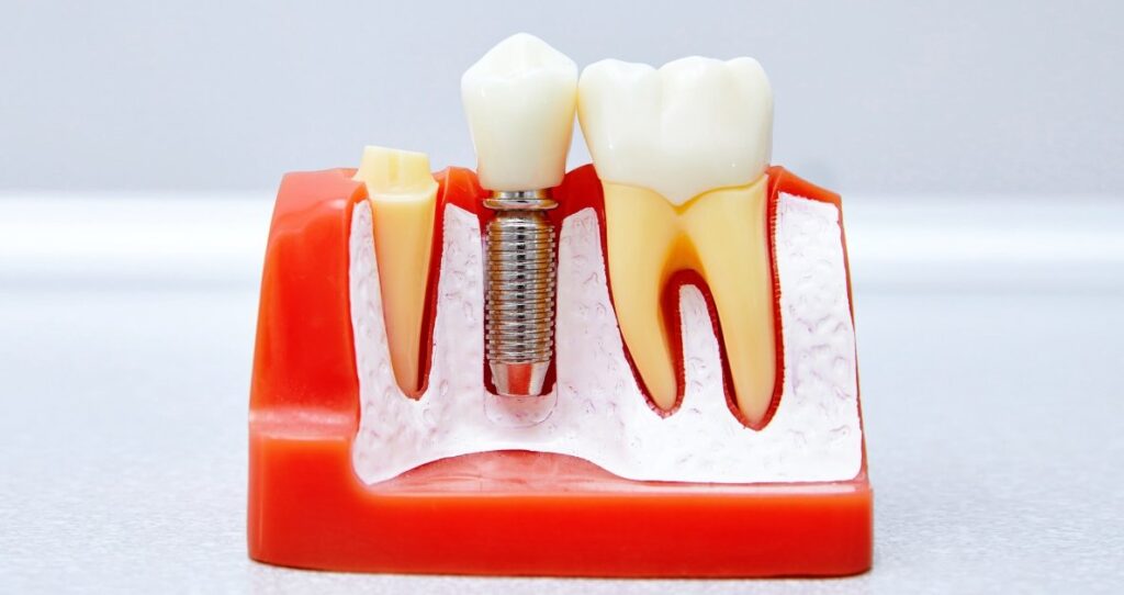 Benefits of Dental Implant