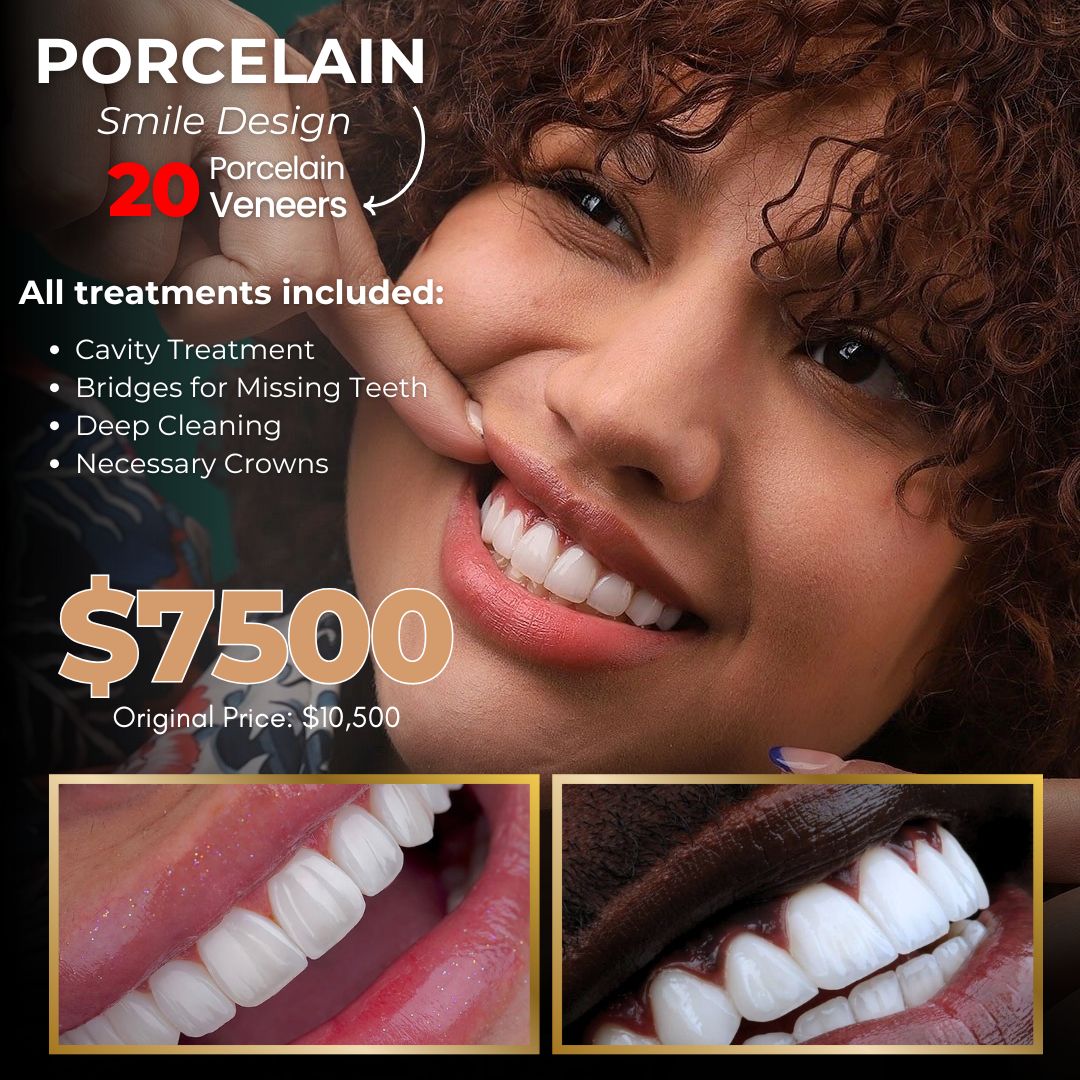 Smile Design Tampa - Porcelain Veneers